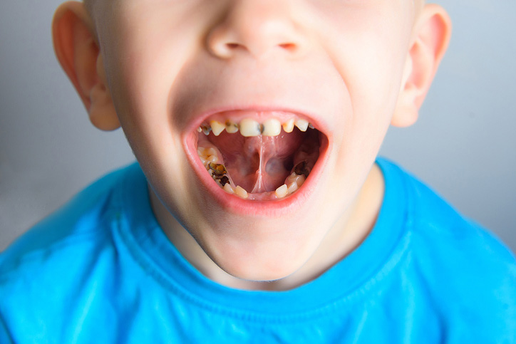 Craze Lines on Teeth: What Are They and What Do You Do?