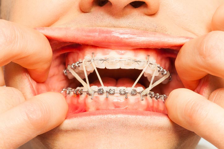 orthodontic elastic gap teeth bands