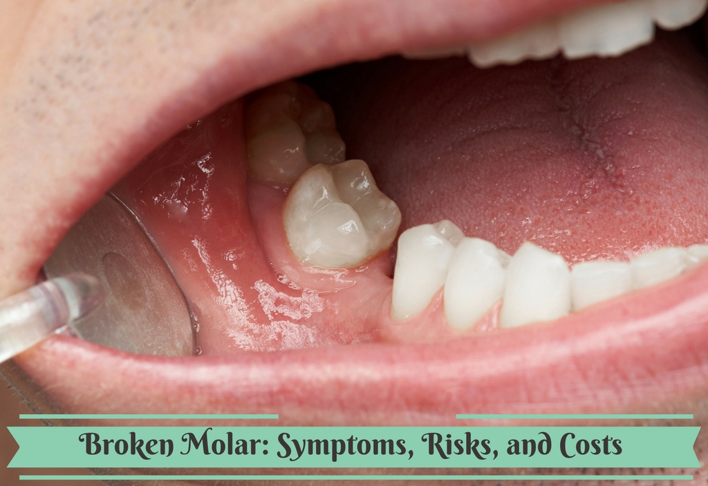 broken molar no pain