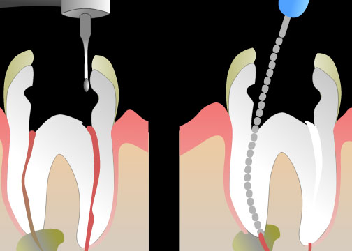 Dental Cysts Understanding And Treating Cysts 3722