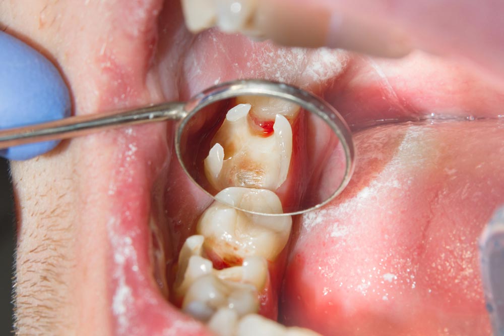 Hole In Tooth What You Need To Know