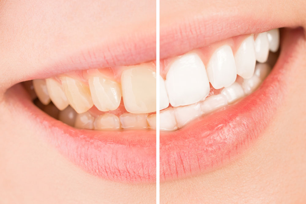 Clear Teeth Causes and Treatments