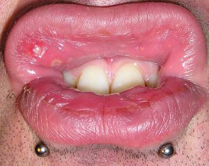 Swelling of the gums