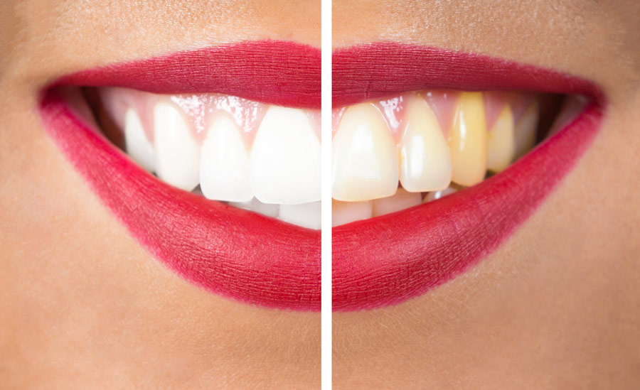 Teeth Whitening Services & Methods: What's Your Best Option?