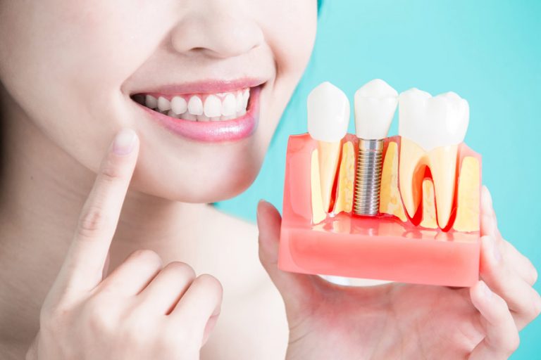 What Are The Pros And Cons Of Dental Implants Our Dentist Explains 6464