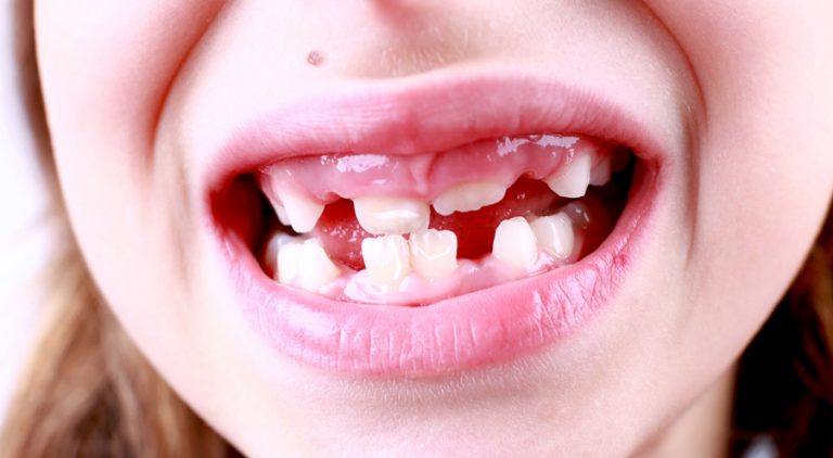 the-most-common-causes-of-white-spots-on-baby-teeth-how-to-prevent-them