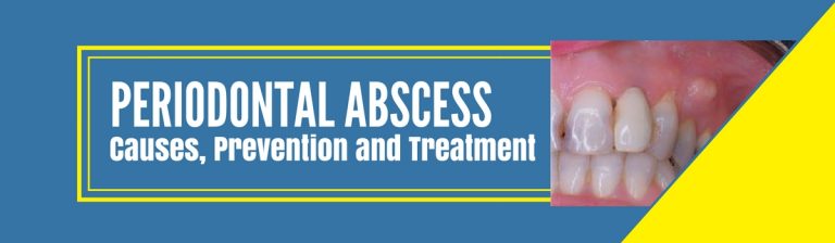 Periodontal Abscess Causes Prevention And Treatment 9681