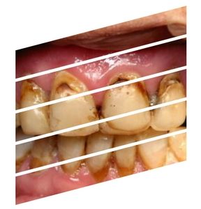 substance abuse and dental care meth mouth